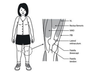 Anterior knee pain (children) — Arthritis Australia