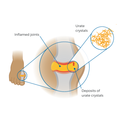 gout-foot-urate